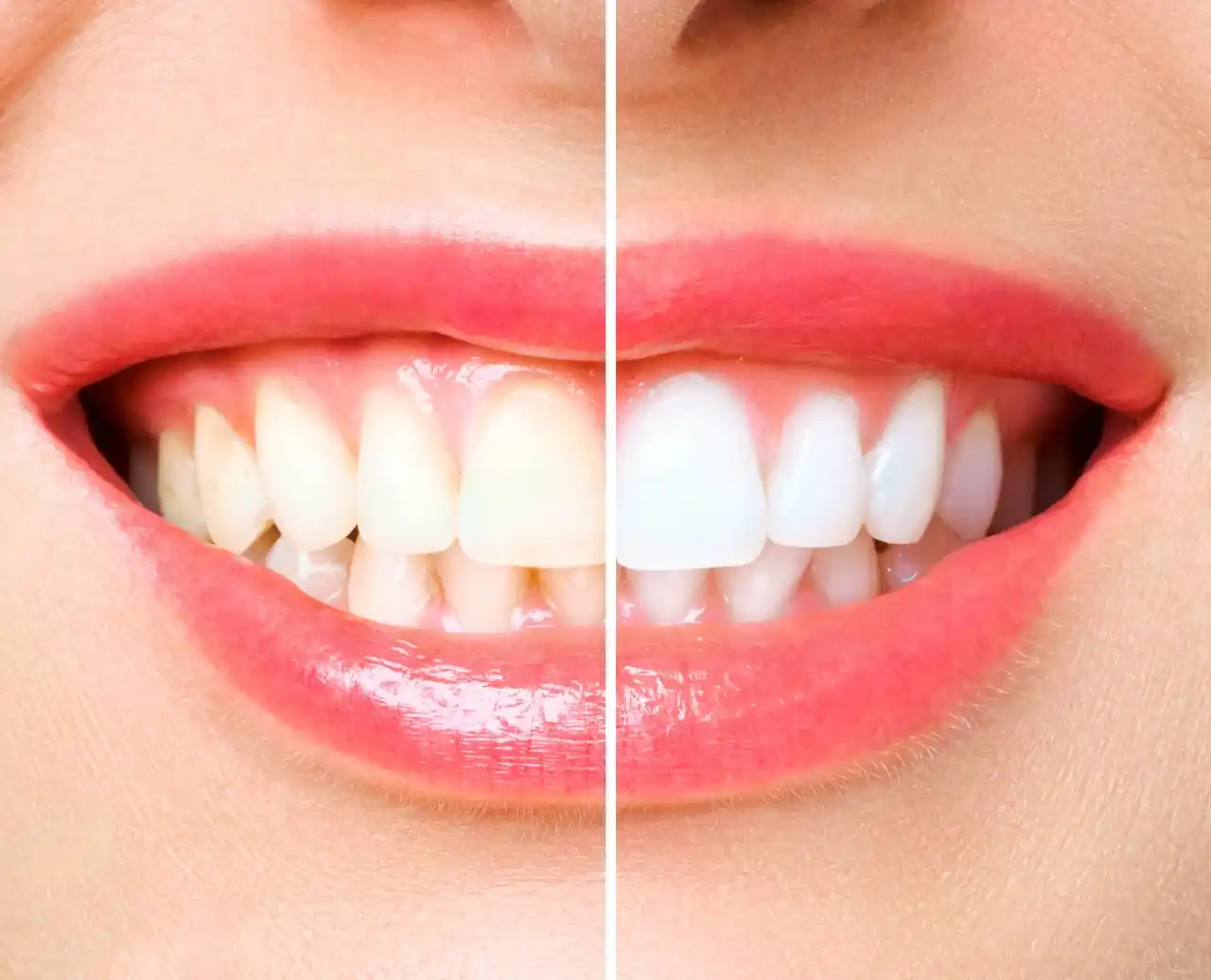 before and after images for dental SEO